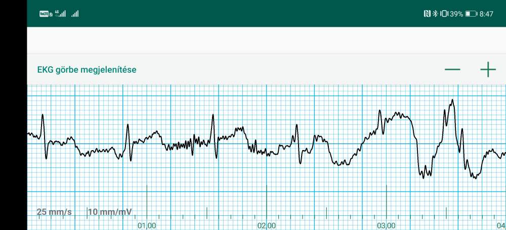 A WIWE mobil alkalmazásában megjelenő EKG mérési eredmény
